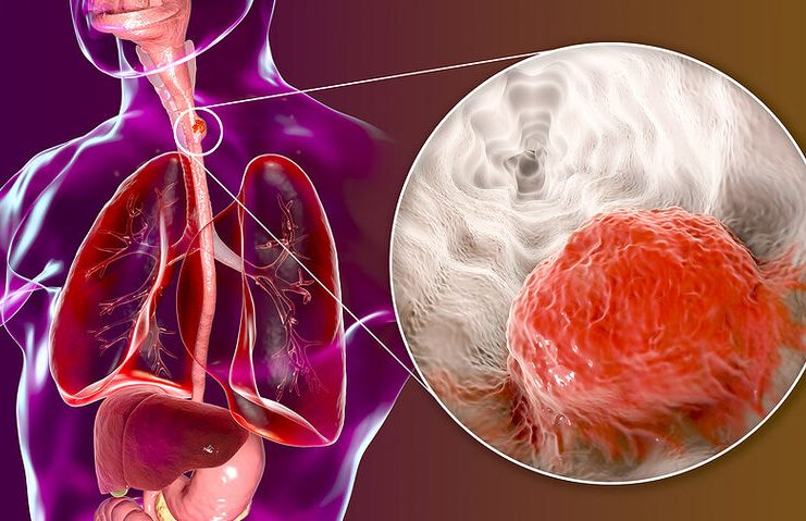 Καρκίνος οισοφάγου: Με ποια συμπτώματα εκδηλώνεται (εικόνες)