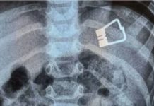 Αγοράκι δυο ετών κατάπιε μανταλάκι στη Λήμνο – Πώς το έσωσαν γιατροί χωρίς χειρουργείο